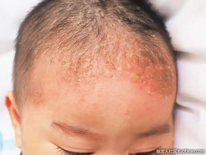 儿童脂溢性皮炎的图片