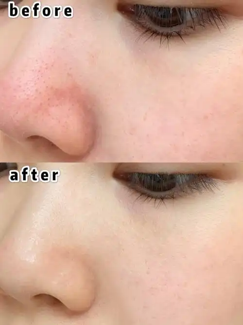 用完毛孔会呼吸!还去啥皮肤管理!省下几百万啊