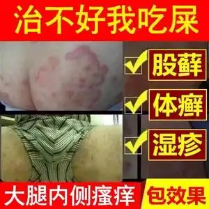 股藓股癣大腿内侧皮肤瘙痒止痒抑菌肛门肛周瘙痒真菌感染外用药膏