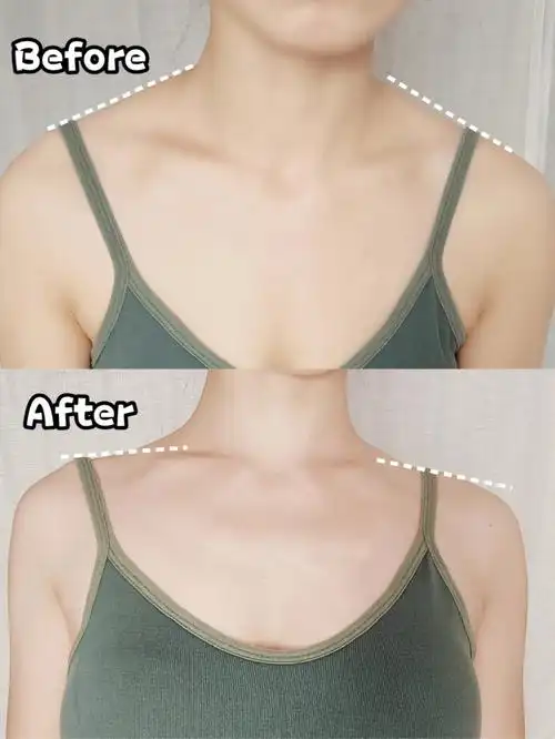 改善圆肩驼背消除斜方肌瘦出直角肩