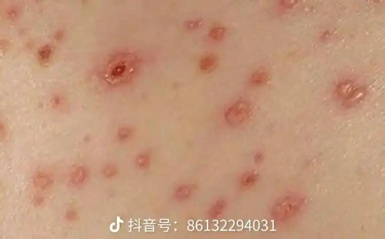 梅毒辨别! - a23495688祖德留方 - 抖音