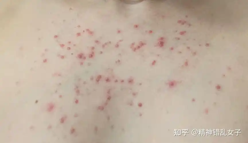 马拉色菌毛囊炎患者的痛苦