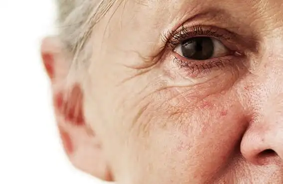 美国耶鲁大学的科学家研究发现,皮肤松弛,皱纹多的女人更易骨折.