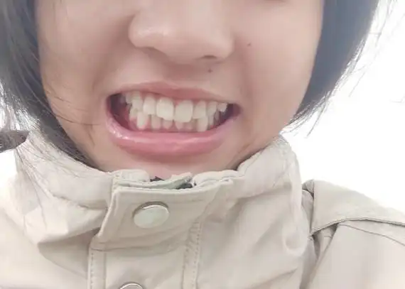 我这算是下面长了颗虎牙吗