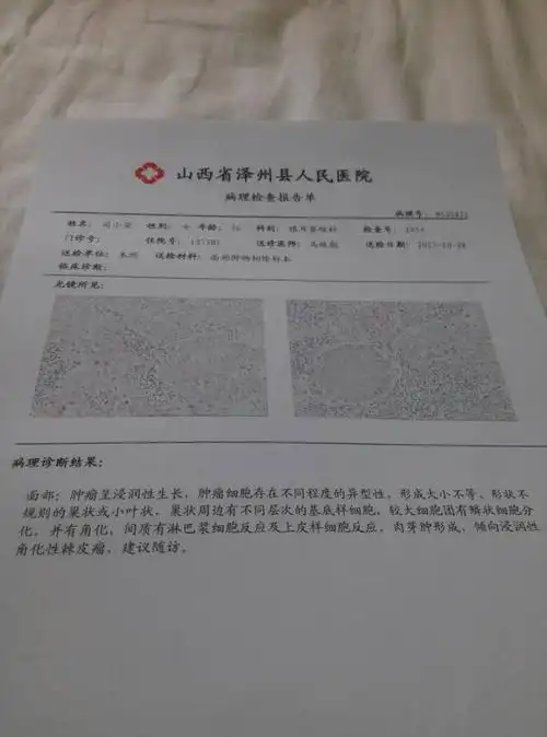 皮肤癌哪治疗会好些,之前奶奶以为是个小疙瘩就又抠又挤,一直拖六七个