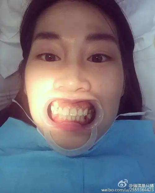 出了一个白包,我回家和我妈说,我怎么牙床长了个囊肿91还是挺惜命的