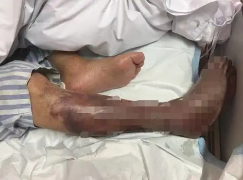 杭州医生苦劝患者截肢保命,家人却说:人可以死,但不能死无全尸!