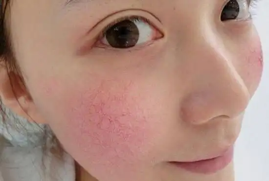 红血丝形成的原因脸上红血丝怎么消除去掉