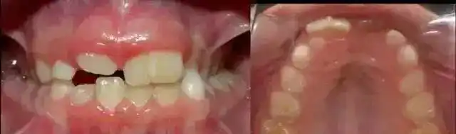 孩子两颗牙长在一起了怎么办