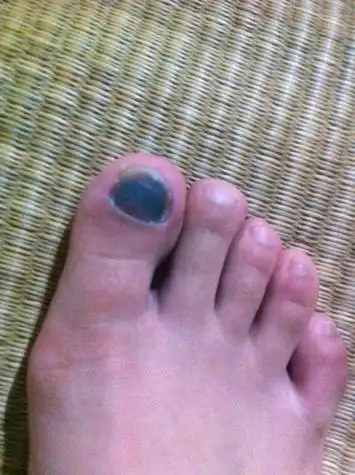 几次跑步之后发现右脚拇指指甲几乎全黑 按上去不疼 一个月左右还不见