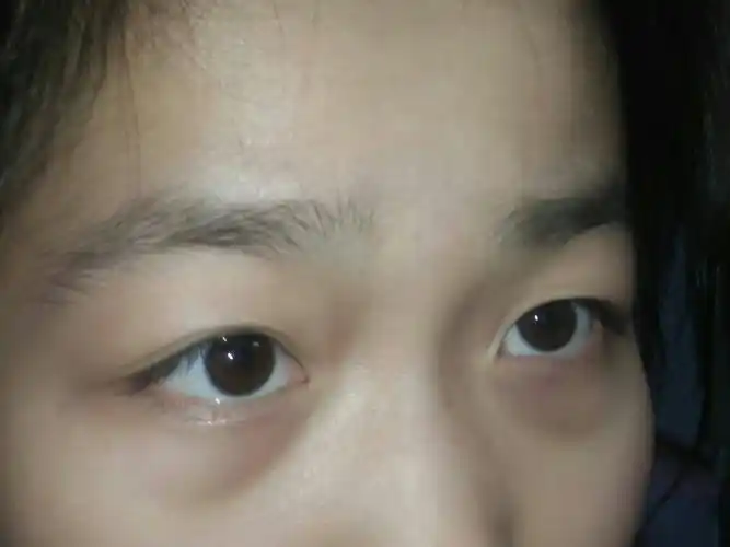 黑眼圈非常的重怎么办?