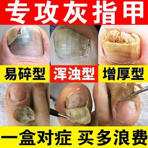 灰指甲专用药】治顽固灰指甲 真菌感染甲癣甲沟炎指甲往肉长指甲发黄