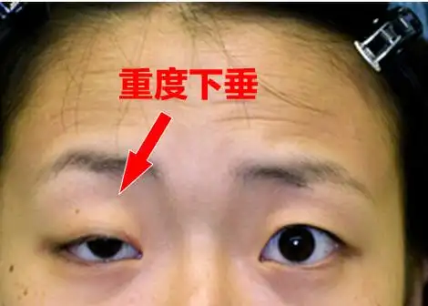 上眼睑下垂该怎样改善-银山主治医师-爱问医生