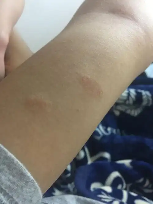 身上突然起红色的很痒的会起皮的也不知道是什么