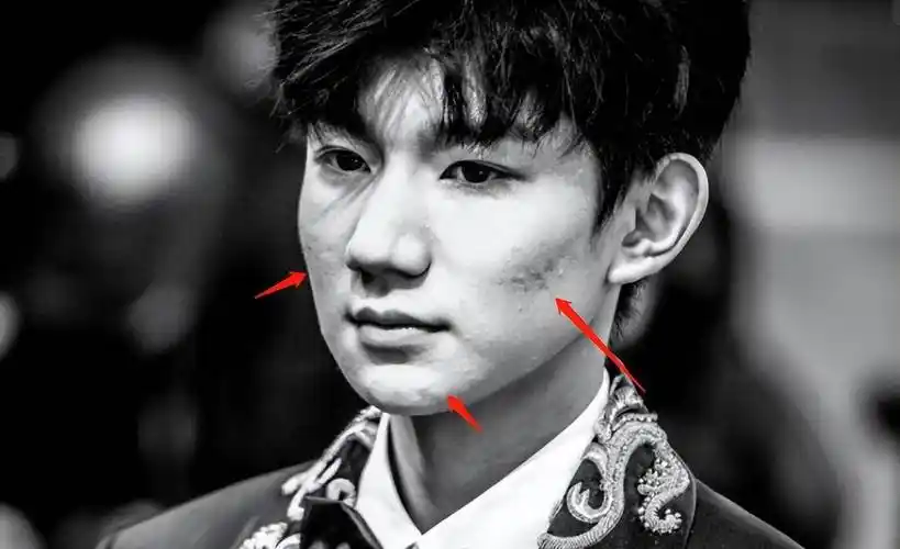 完美男神是假的,脸型崎岖,满脸痘印,生图揭露人间真实_王源_减肥_什么