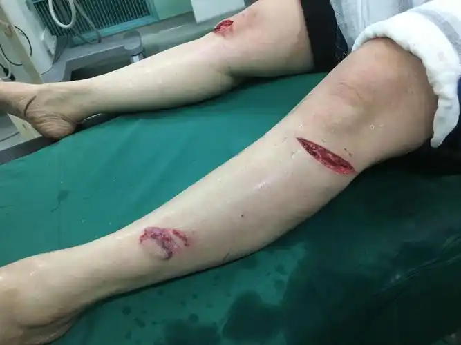 全身多处刀砍伤