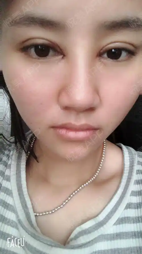 埋线双眼皮 开内眼角 术后1天