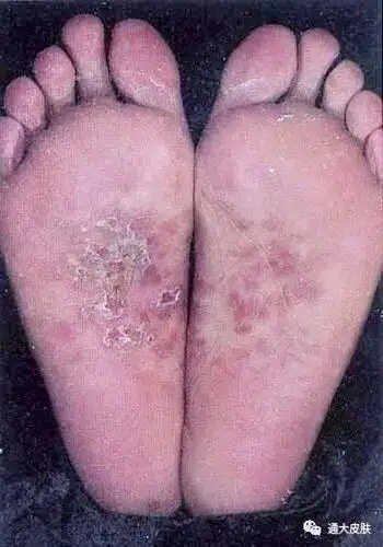 因为它所引起临床症状,往往并不局限于皮肤的常见表现,如下面这些看似