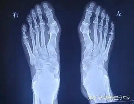 如果大脚骨手术不是削掉骨头那么到底应该怎么做才好呢