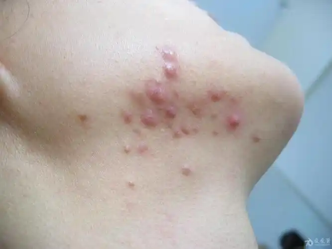 糠粃孢子菌毛囊炎