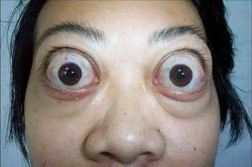 胫前粘液水肿!甲亢的病理症状你知道吗?