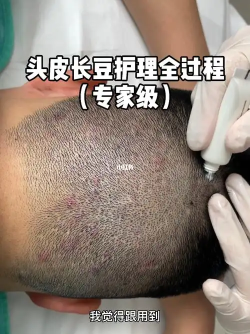 头皮护理全过程长沙皮肤管理痘痘头皮