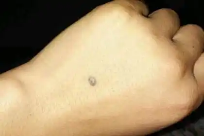 手背痣相图解手背长痣代表什么