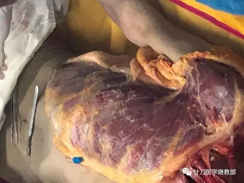 针刀提高班本班特色:1,实体解剖:在北京大学医学部解剖教研室进行标本