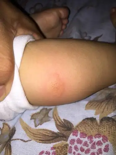 16个月的宝宝小腿上出现一块小红包,上面好像是水泡,严重不?