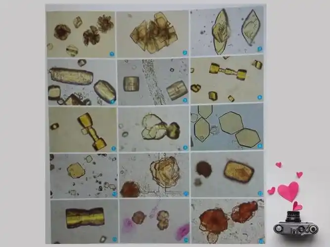 尿液沉渣中可见的结晶.