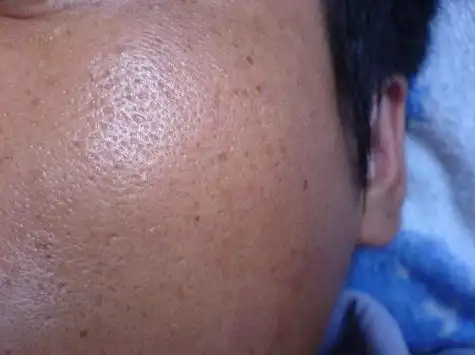 皮肤出油毛孔粗大怎么办『皮肤出油毛孔粗大怎么办小妙招』