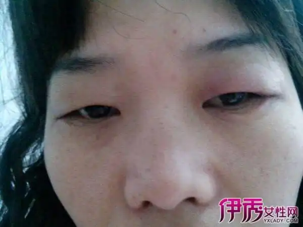 500x343 - 31kb - jpeg 消除眼睑水肿的两大常见方法 1,除了晚上要少