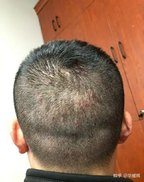 毛囊炎如何根治有什么好的办法