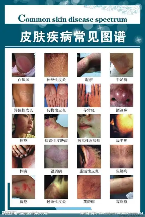 2,牛皮癣,头癣,顽癣:猪胆一个,刺破,将胆汁放在小碗内,加入明矾如