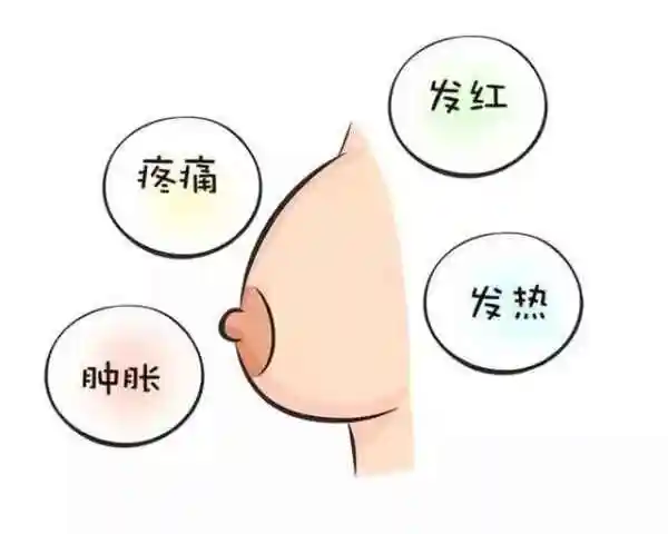 胀奶一般分为两种情况:正常是乳房涨,但宝宝吃完奶后乳房就软了,这样