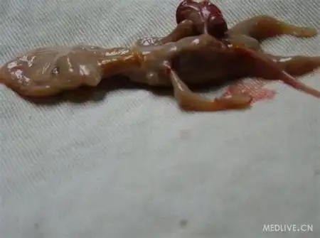 引产是把胎儿夹碎还是生出来