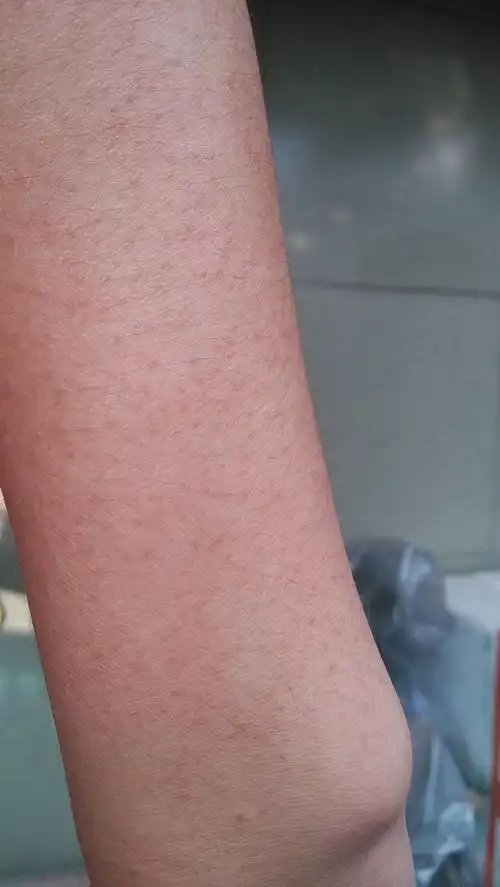 我的手臂是怎么回事,有什么方法可以治好?