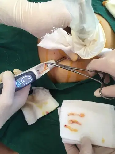 独特空心针穿刺,手术全程只一次穿刺,避免肿瘤细胞脱落的针道转移.