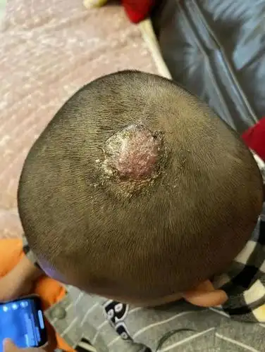 儿子头皮长包化脓治不好,"罪魁祸首"竟是家里的它