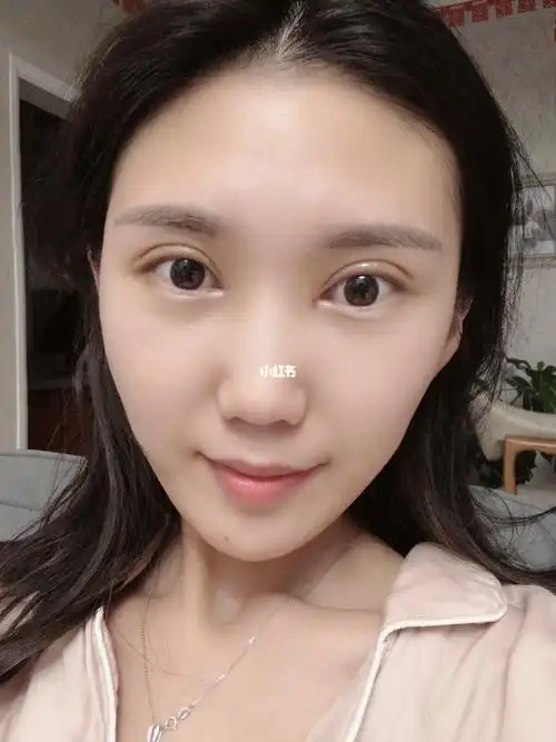 全切双眼皮第8天_双眼皮手术_美妆_医美整形