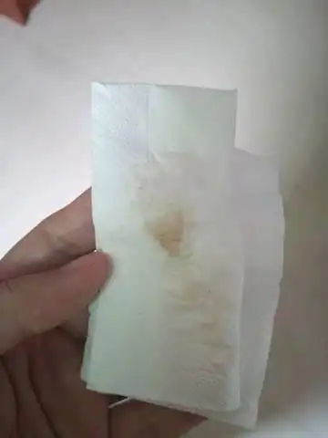 上小便有这个褐色分泌物,没其他问题,这样要不要看医生?