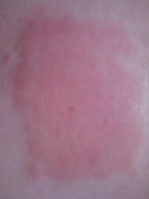 2013-11-30 徐家君 医师 我的脸部皮肤过敏有七天了.吃了好多药.