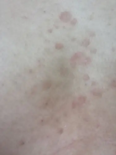 胸口偶尔会痒,刚开始是一个红色小点,一抓