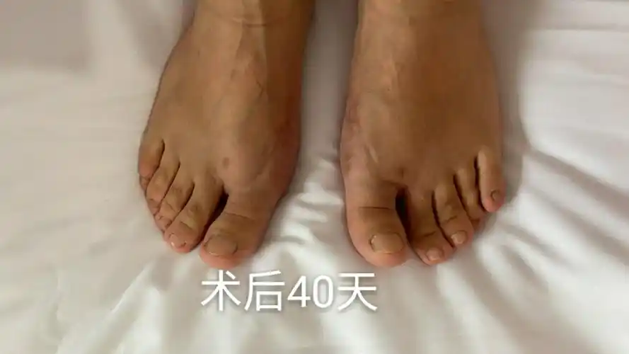 河套医院曾俊华骨外科著名专家,微创治疗踇外翻,轻松告别大脚骨!