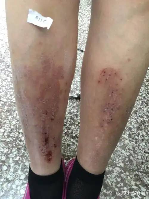 皮肤科医生与你共同面对湿疹复发