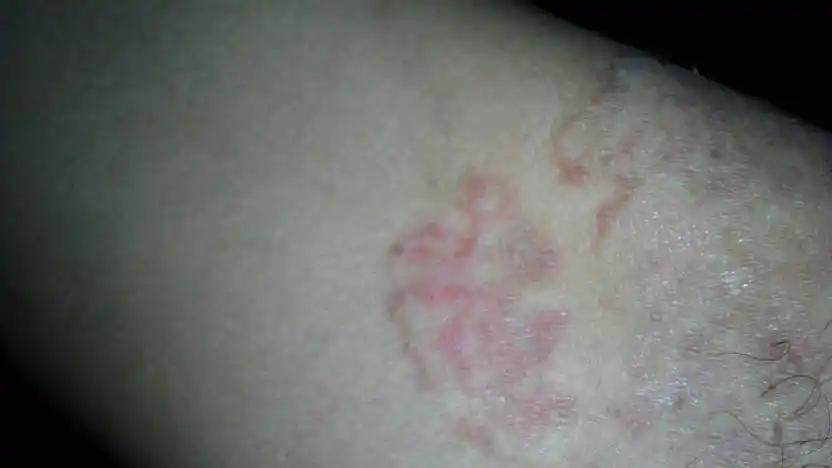 2013-12-17 秦爱洁 医师 裆部湿疹瘙痒难忍,请问该怎么治疗?