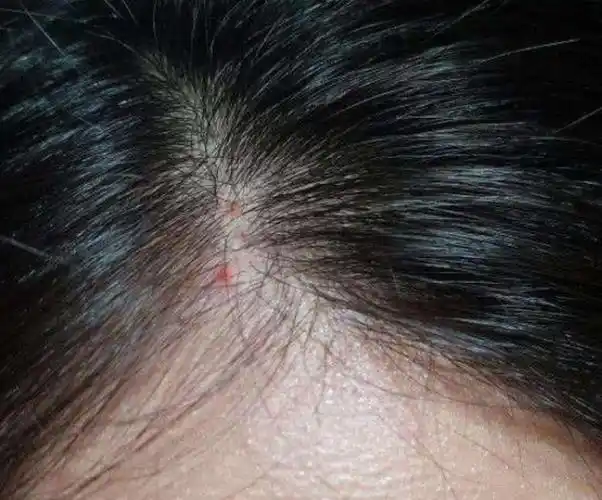 堵dǔ塞毛囊引起痘痘产生shēng,严重将会使得头皮pí发生shēng炎症