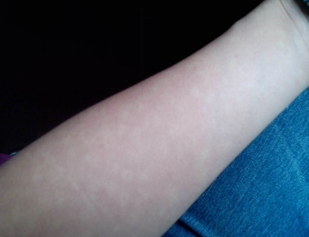 汗斑图片大全51