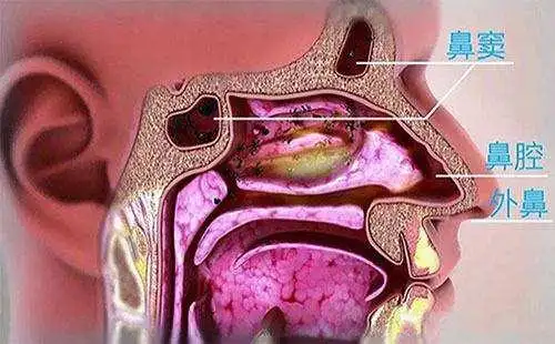 息肉,多导致双侧嗅觉下降,鼻中隔偏曲,鼻乳头状瘤和鼻腔肿瘤则多为单