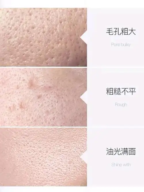 【辨别自己的毛孔类型】选择正确的收缩毛孔的方法!